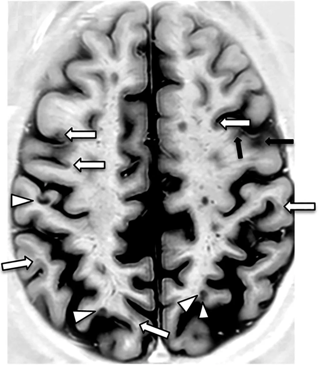 Axial PSIR MRI of a brain with multiple sclerosis lesions